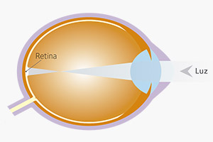 Diferencias entre ojo normal y ojo miope